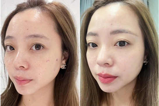 有結痂的皮秒雷射：找回水煮蛋肌｜台中仲夏美形-變美找安英總監