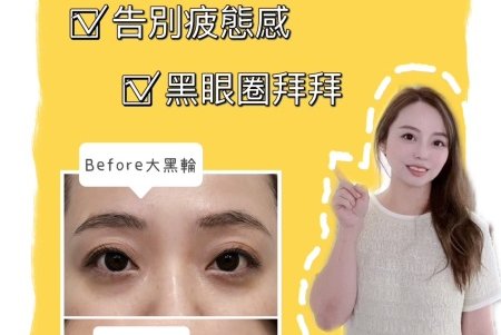 告別黑眼圈-膠原蛋白熊貓針｜台中仲夏美形診所-變美找安英總監