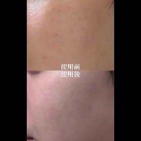 七天刷酸能有效拋光+減少痘疤！